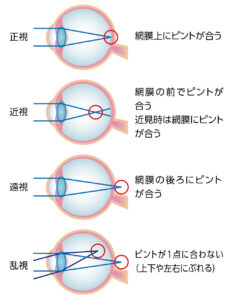 弱視は早期発見が大切です✨❕❕